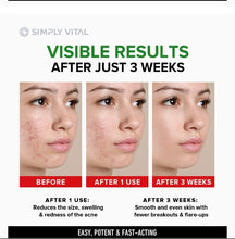 Load image into Gallery viewer, Vitamin E acne &amp; dark spot cream(50g)